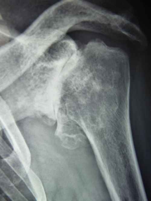 Traitement des fractures - Orthosud Montpellier