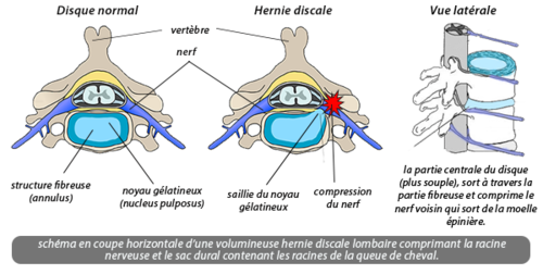 La sciatique par hernie discale Toulouse - Unité de Pathologies Rachidiennes